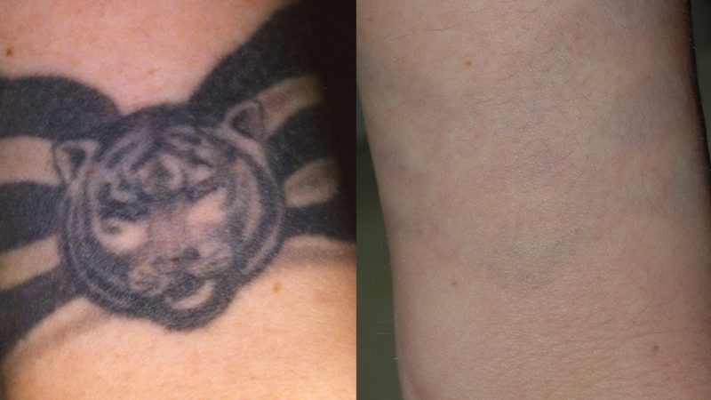 Tattoo Removal Pictures